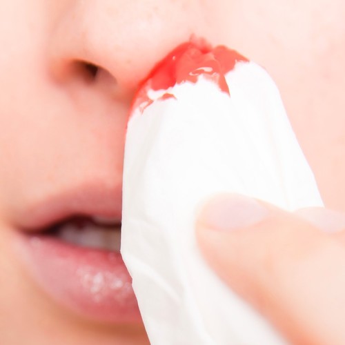 Sposoby na powstrzymanie krwawienia z nosa