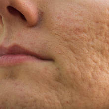 Jak pozbyć się blizn po trądziku?