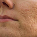 Jak pozbyć się blizn po trądziku?