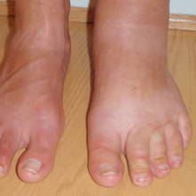 Objawy oraz leczenie obrzęku limfatycznego