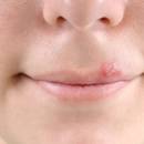 Jakie są sposoby na pozbycie się opryszczki?