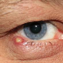 Sposoby leczenia jęczmienia na oku