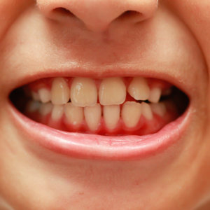 Przyczyny zapalenia dziąseł