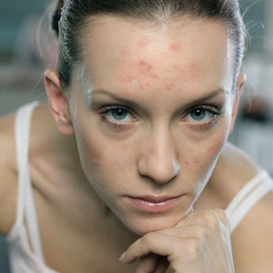 Przyczyny trądziku u dorosłych