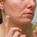 Naturalne sposoby na blizny po trądziku