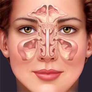 Przeczyszczenie nosa