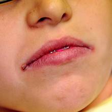 Skuteczne domowe sposoby na zajady