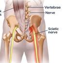 Jak skutecznie leczyć rwę kulszową?