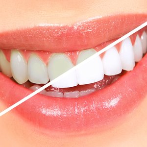 Krwawienie dziąseł