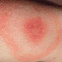 Jak rozpoznać i leczyć boreliozę?