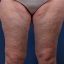 Jak szybko i skutecznie pozbyć się cellulitu z ud?