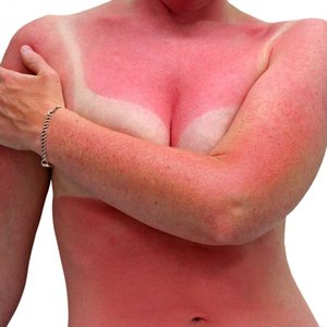 Jakie są objawy udaru słonecznego?