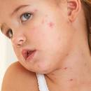 W jaki sposób łagodzić podrażnienia na twarzy?