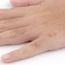 Skuteczne sposoby walki z kurzajkami