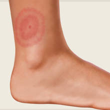 Jakie objawy są charakterystyczne dla boreliozy?