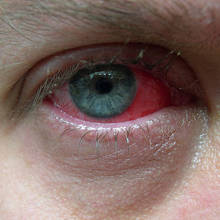 Jak rozpoznać zapalenie spojówek?