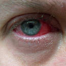 Jak rozpoznać zapalenie spojówek?