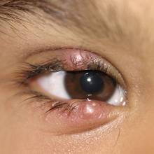 Jak wyleczyć jęczmień na oku domowymi sposobami?