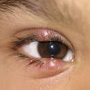 Jak wyleczyć jęczmień na oku domowymi sposobami?