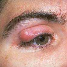 Jak wyleczyć jęczmień na oku?