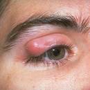 Jak wyleczyć jęczmień na oku?