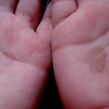 Domowe sposoby na grzybicę skóry