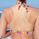 Proste domowe sposoby na oparzenia słoneczne