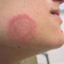 Jak zapobiegać grzybicy skóry?