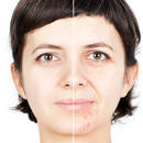 Pomysły na usunięcie blizn po trądziku