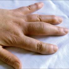 Co oznaczają opuchnięte palce rąk?