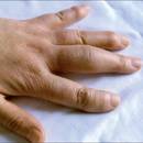 Co oznaczają opuchnięte palce rąk?