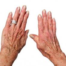 Domowe sposoby na reumatyzm