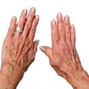 Domowe sposoby na reumatyzm