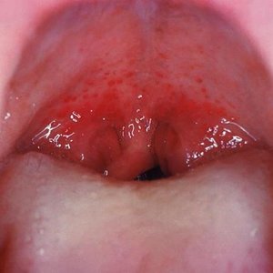 Zaczerwienienie gardła