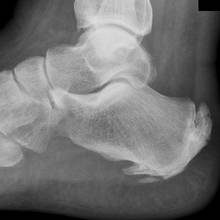 Ostroga piętowa – co to jest i jak ją leczyć?