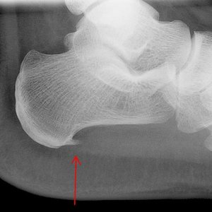 Przyczyny ostrogi piętowej