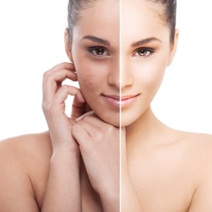 Złuszczanie naskórka