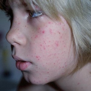 Ograniczenie kontaktu