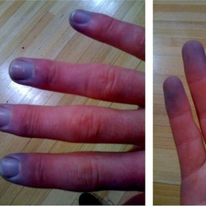 Czego unikać podczas choroby?