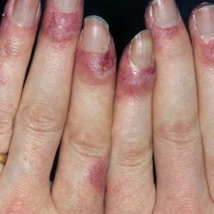 Leczenie choroby Raynauda