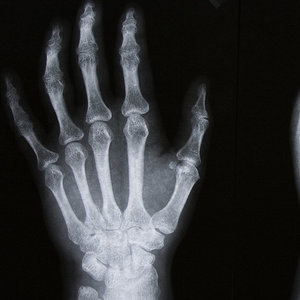 Poważniejsze postaci choroby