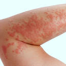 Skuteczne sposoby leczenia pokrzywki alergicznej