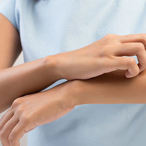 Pokrzywka – objawy