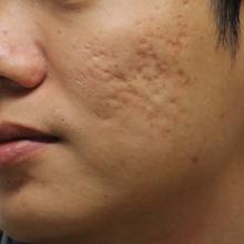 Skuteczne i nowoczesne sposoby usuwania blizn