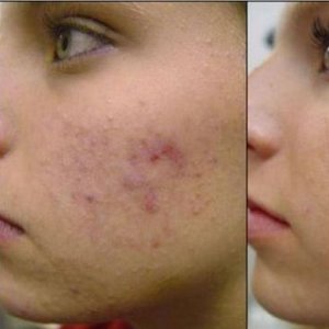 Metoda pierwsza – laseroterapia