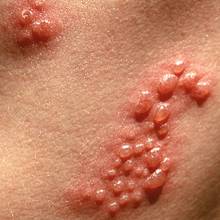 Naturalne sposoby na półpasiec