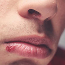 Prosty sposób na leczenie zajadów