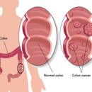 Jakie są symptomy raka jelita grubego?