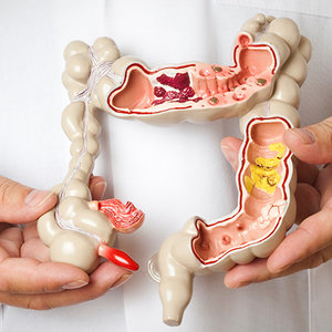 Przyczyny raka jelita grubego