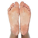 Jak skutecznie usunąć odciski płynem Acerin?